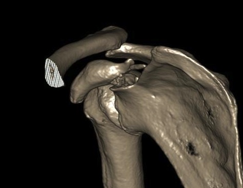 Coracoid Fracture CT 3